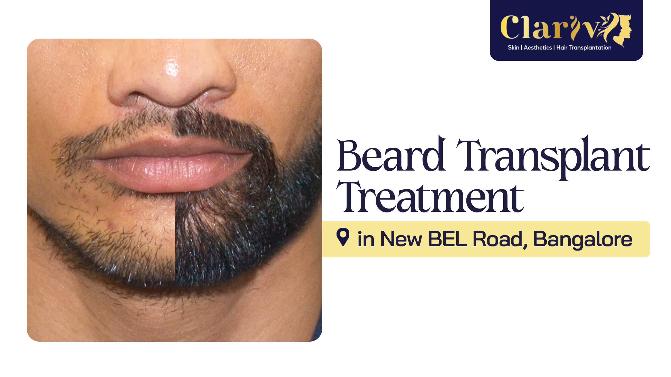 Beard Transplant in New BEL Road, Bangalore