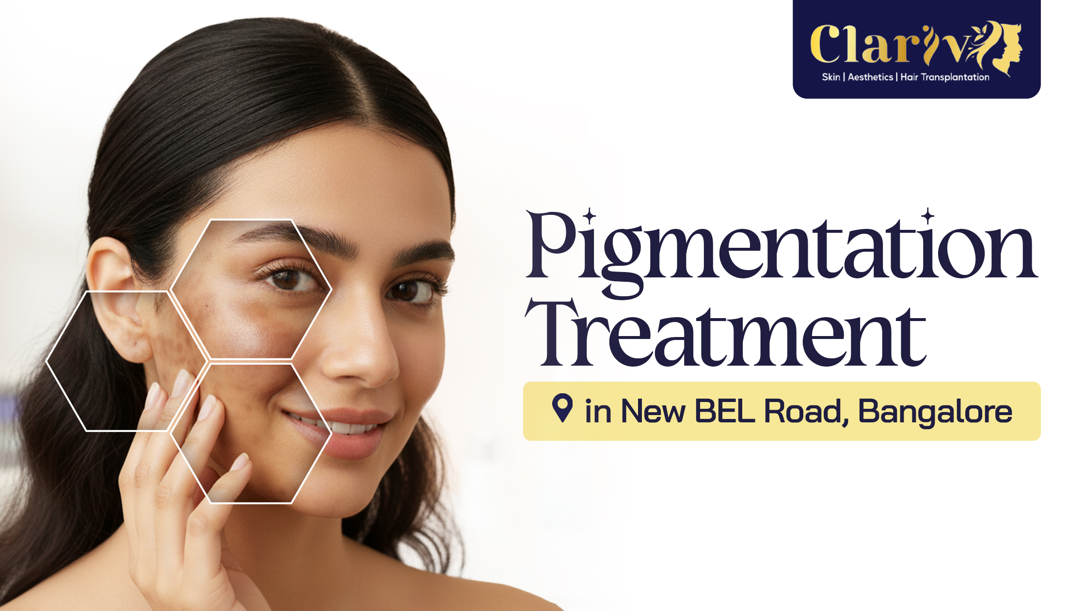 Pigmentation Treatment in New BEL Road