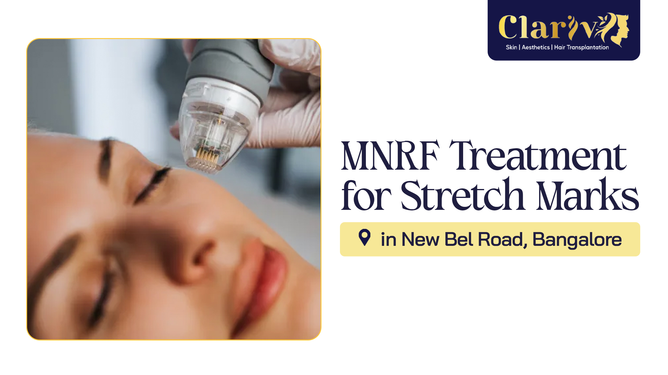 MNRF for stretch marks in Bangalore