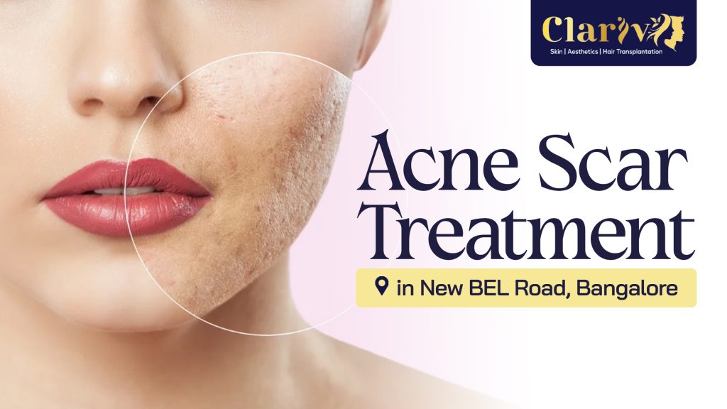 Acne Scar Treatment in New BEL Road, Bangalore