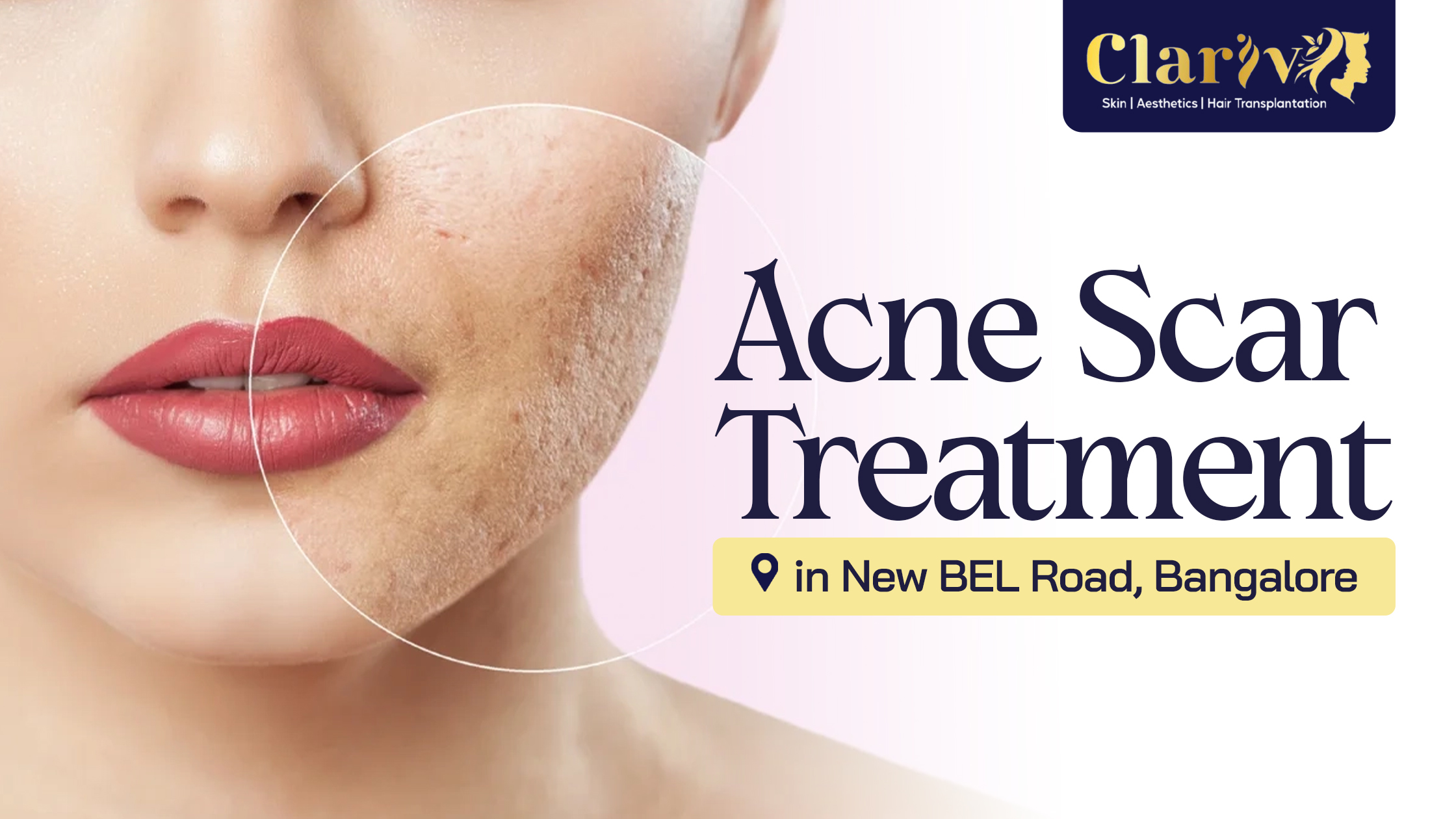Acne Scar Treatment in New BEL Road, Bangalore