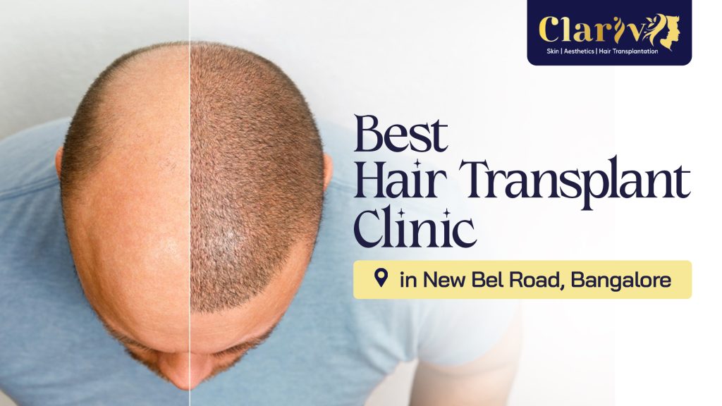 Best Hair Transplant Clinic in New BEL Road, Bangalore