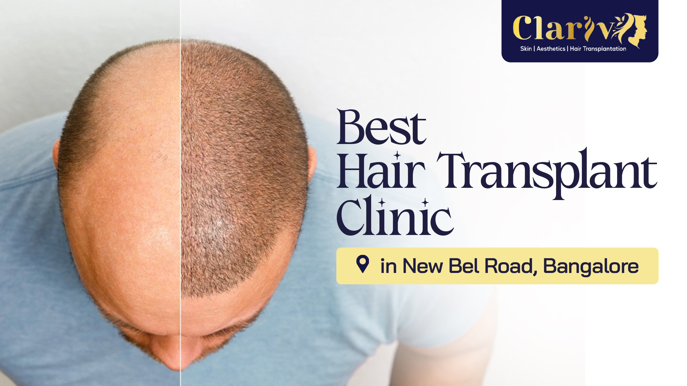 Best Hair Transplant Clinic in New BEL Road, Bangalore